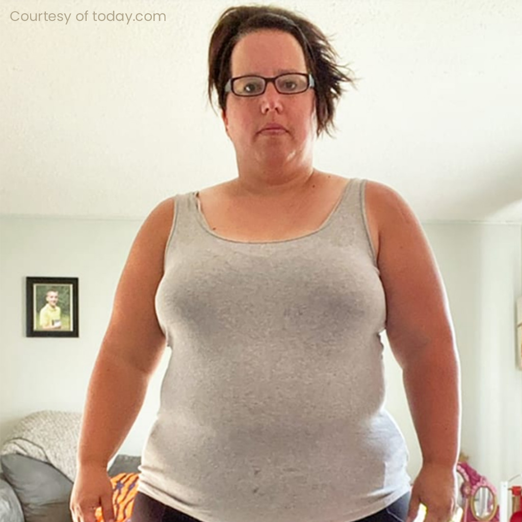 Weight loss patient before and after