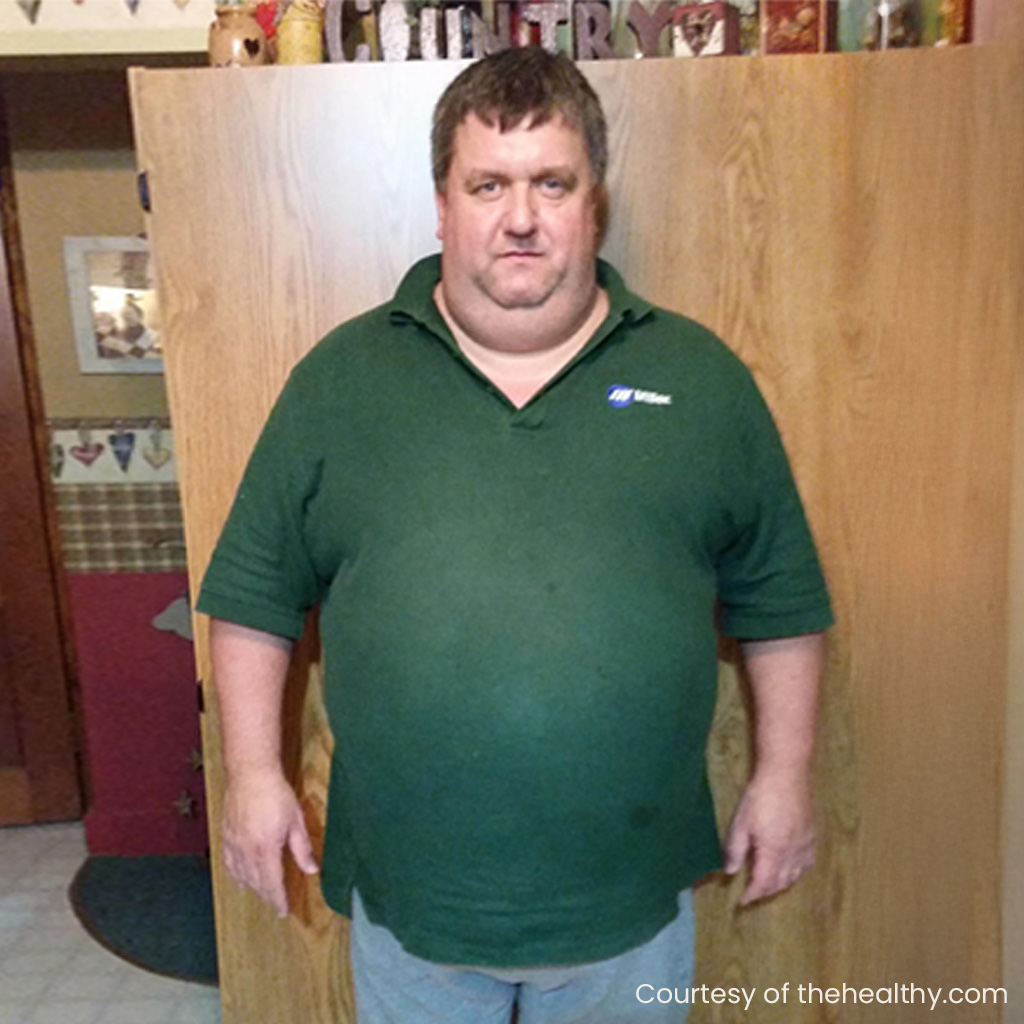 Weight loss patient before and after